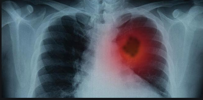 Akciğer embolisi nedir Tedavisi nasıl olur