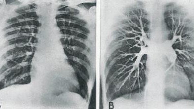 Akciğer Embolisi Nedi
