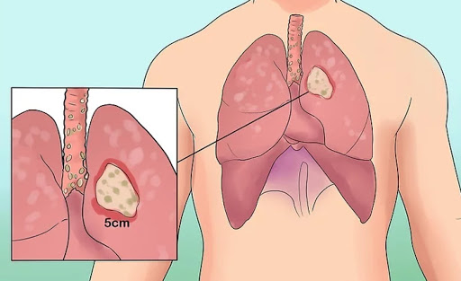 Akciğer Kanseri Belirtileri, Yaşam Süresi Ve Tedavisi