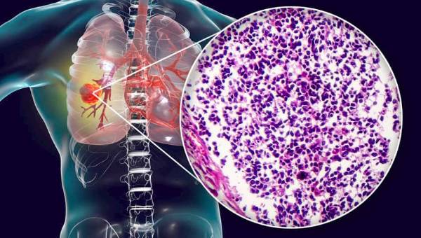 Akciğer Kanseri Belirtileri ve Tedavi Yöntemleri